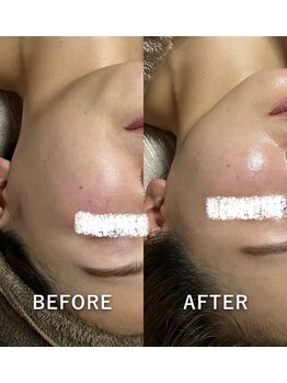 リュミエール(Lumiere)/毛穴洗浄で小顔