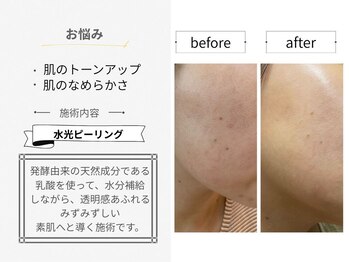 シロ(CHILO)/水光ピーリング