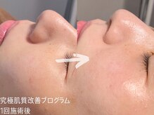 ルーナジェーナ(Luna llena)/究極の肌質改善プログラム