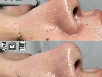 ニコ アンド キャンディー(Nico.&Candy)/毛穴も小さく肌トーンアップ♪