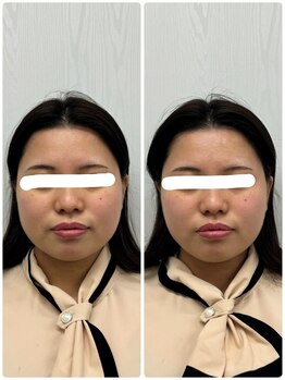 ラフテル鍼灸整骨院/美容鍼×小顔整体で30分で小顔！