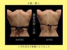 ブルースター 上小田井店(Blue Star)/お腹２・背中２カップ×２回