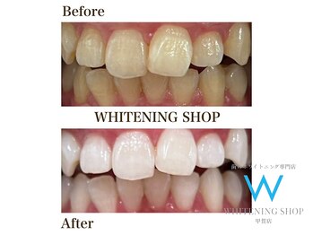 ホワイトニングショップ 甲賀店/Before&After『ホワイトニング』