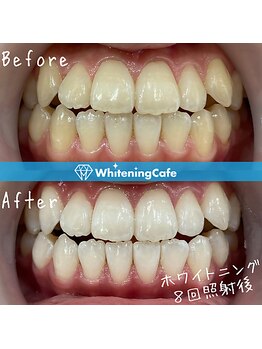 ホワイトニングカフェ 和歌山ガーデンパーク店(WhiteningCafe)/8回照射症例