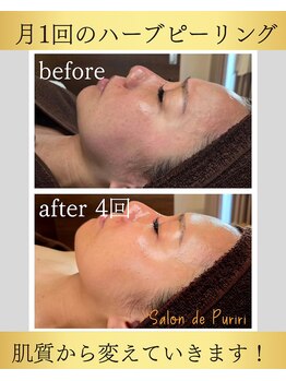 サロン ド プリリ(Salon de Puriri)/ハーブピーリング