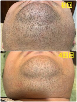 アシュレ リル 西多賀店(assure Lilou)/メンズ髭脱毛☆