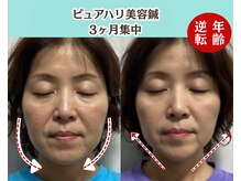 ピュアハリ/沖縄美容鍼/たるみ/効果