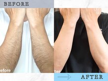 ラッシュ(RUSH)/10回の施術でこんなに変わる！！