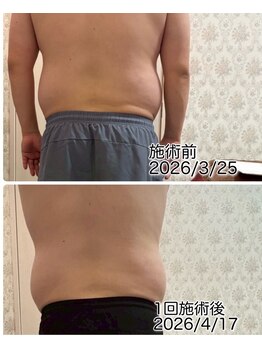 クールスパ(COOL SPA)/男性背中症例
