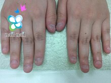 ネイルネイル 南森町店(nailnail)/深爪（before） 