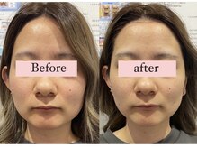 アリウム(Allium)/痩身機械で小顔へ