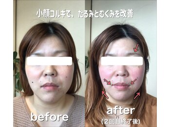 ハッピーアロマ みんと/【小顔コルギ】