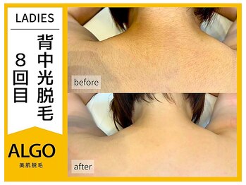 アルゴ 福井店(ALGO)/一番気になる背中脱毛！