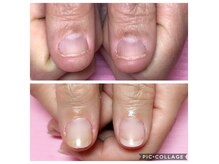 シンシアリー 新小岩店(Sincerely)の雰囲気（深爪・噛爪でお悩みの方に深爪改善コース）