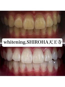 シロハ(SHIROHA)/セルフホワイトニング/天王寺