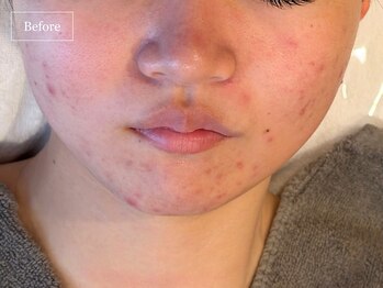 キュレイテッドスキン(CURATED SKIN)/ピーリング/毛穴ケア/肌質改善