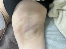 ナノハナ/鹿沼市の全身脱毛美容室ナノハナ