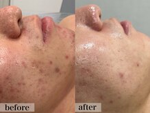 エステサロン ジョアアンジェ(joie ange)/コモデックス　3回