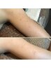 リピーター用★剥離有ハーブピーリング【ボディ】 両二の腕　25000→23000円