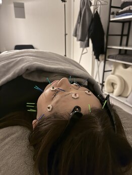 ラフテル鍼灸整骨院/美容鍼灸で眼精疲労改善♪