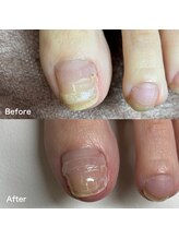 リリ(lili)/巻き爪矯正2回目（左親指） 