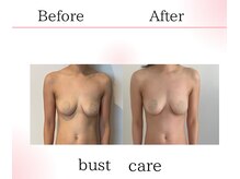 サロンツキ(salon tuki)/バストアップ/バストケア/症例