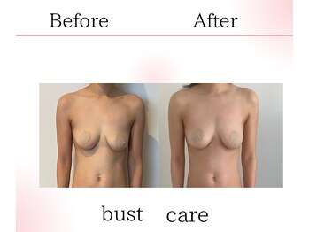 サロンツキ(salon tuki)/バストアップ/バストケア/症例