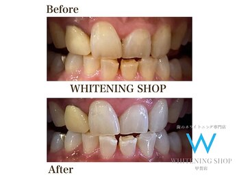 ホワイトニングショップ 甲賀店/Before&After『ホワイトニング』