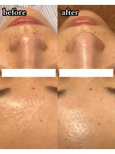 ニューズビューティー(neu's beauty)/ワックス × 毛穴洗浄♪