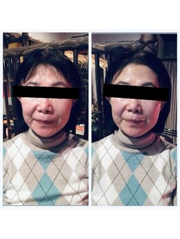 ぐりーんりぷる/金箔エステ1回の変化！