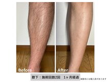 クリアボディ(CLEAR BODY)の雰囲気（都度払い！2回でこの変化◎残り1年のセールなので勧誘も一切なし）