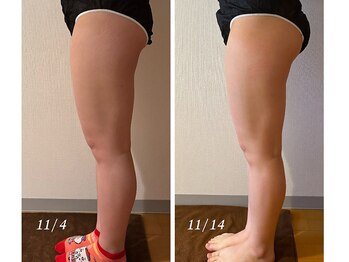 アイリーボーテ 東大阪(アイリーBEAUTE)/美脚・美尻コース3回