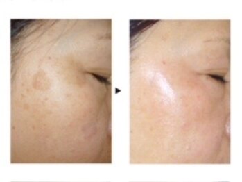 ケートータルビューティー(K. total beauty)/純粋レチノールピールエステ4