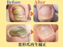 巻き爪補正店 北千住店の雰囲気（巻き爪・陥入爪・分厚く変形した変形爪でお悩みの方へ［変形爪］）