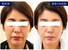 サロンドエステケイワイ(de KY)の雰囲気（50代、１度の施術後で法令線・輪郭がVラインに。リフトアップ）