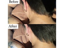 ビマナ 小岩店(NU美Mana)/【Men'sうなじ脱毛】