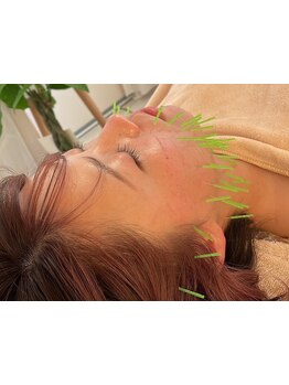 鍼灸施術を受けたい