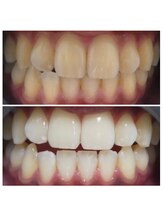 ホワイトニングカフェ 藤が丘店(WhiteningCafe)/プレミアムホワイトニング☆