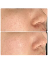 ラウレア(Laule'a)/大人肌の毛穴・くすみケア