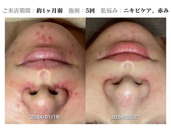 お顔ラボ AOYAMA(お顔LABO)/スキングローピール5回のお客様