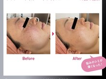 エミー(emy)/江坂/毛穴/ハーブピーリング