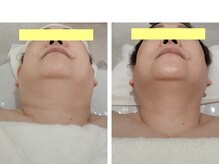 ジ エステティック イーズ サクラマチ熊本店/ビフォーアフター1