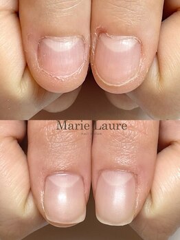 マリーロール 梅田店(Marie Laure)/自爪育成/深爪矯正/ネイルケア
