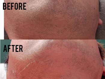 エイプリルプラス(April plus)/髭脱毛