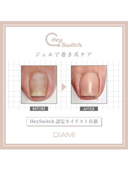 ル リアン 北浦和(le lien)/【巻き爪ケア】ヘイスイッチ