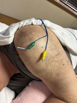 ライズ/肩への鍼通電を用いた施術