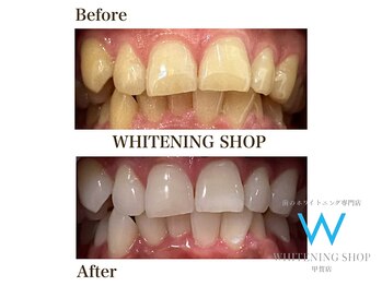 ホワイトニングショップ 甲賀店/Before&After『ホワイトニング』
