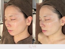 ルーミー 南青山(LUME)/セラピール／水光肌／ツヤ