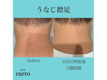 アクト クロ(ACT curro)/【うなじ襟足】脱毛施術例