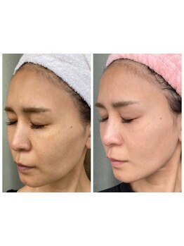 シミしわ改善！予防ケア